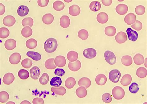  Babesia:  The Tiny Parasite That Can Make Your Blood Run Cold!